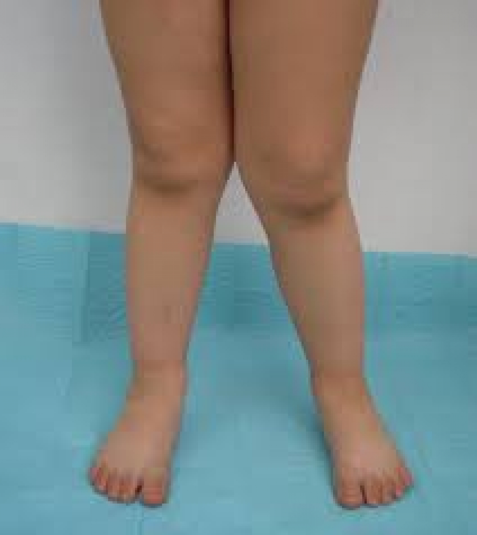 gambe storte Specialista in Ortopedia Pietro Persiani